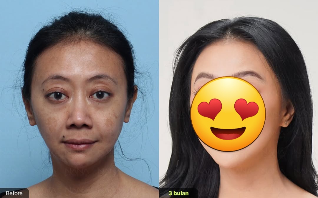 Bikin Pangling, Asri Welas Bagikan Potret Before dan After Operasi Plastik di Korea
